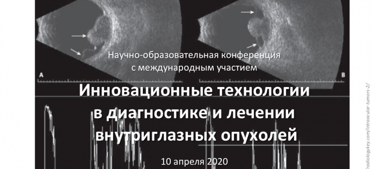 Офтальмоонкология Внутриглазные опухоли 10 апреля 2020 Анонс