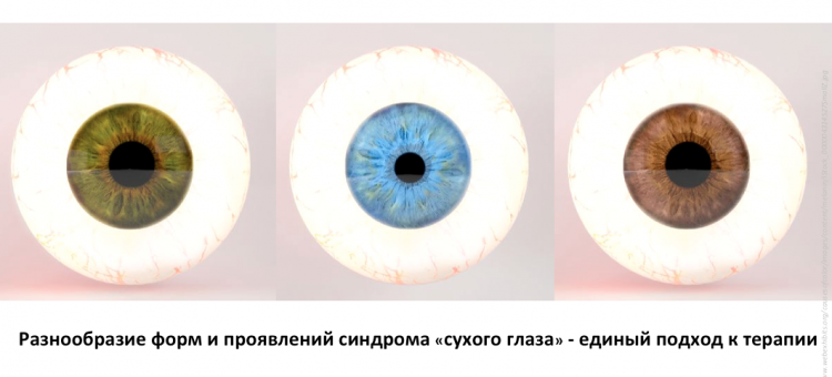 Сухой глаз Лечение