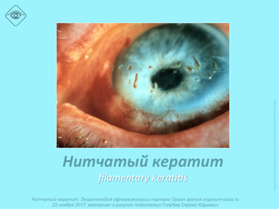 Лечение сухого глаза Нитчатый кератит