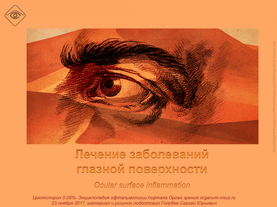 Лечение сухого глаза Циклоспорин 0,05%