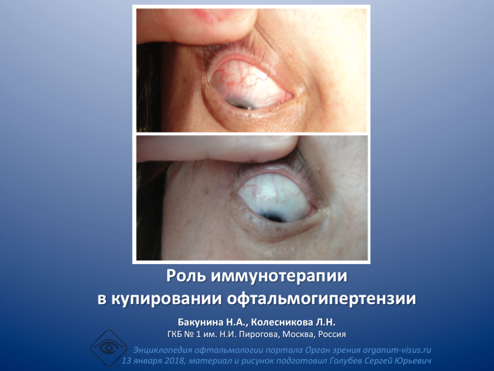 Рестасис при отечном экзофтальме