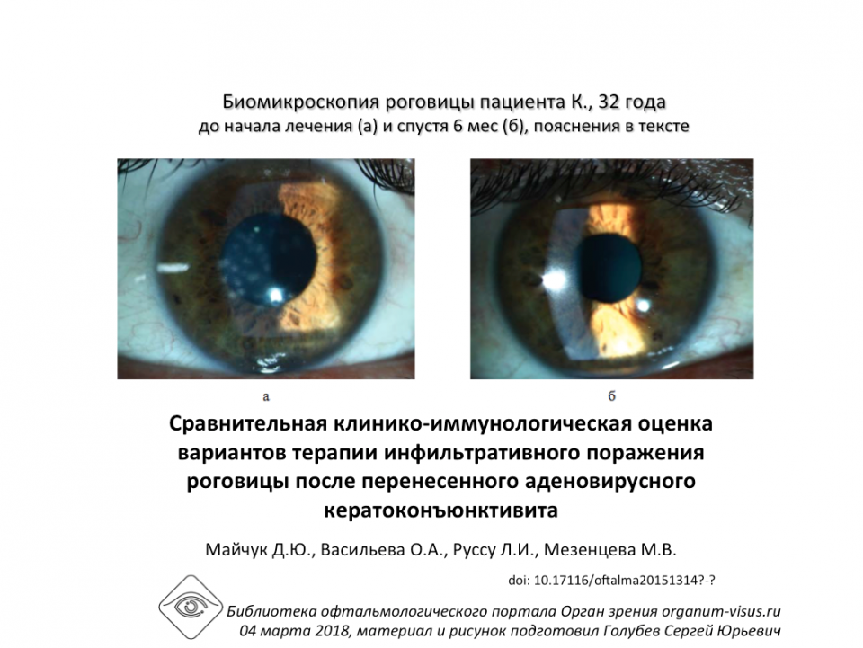 Рестасис Лечение аденовирусного кератоконъюнктивита