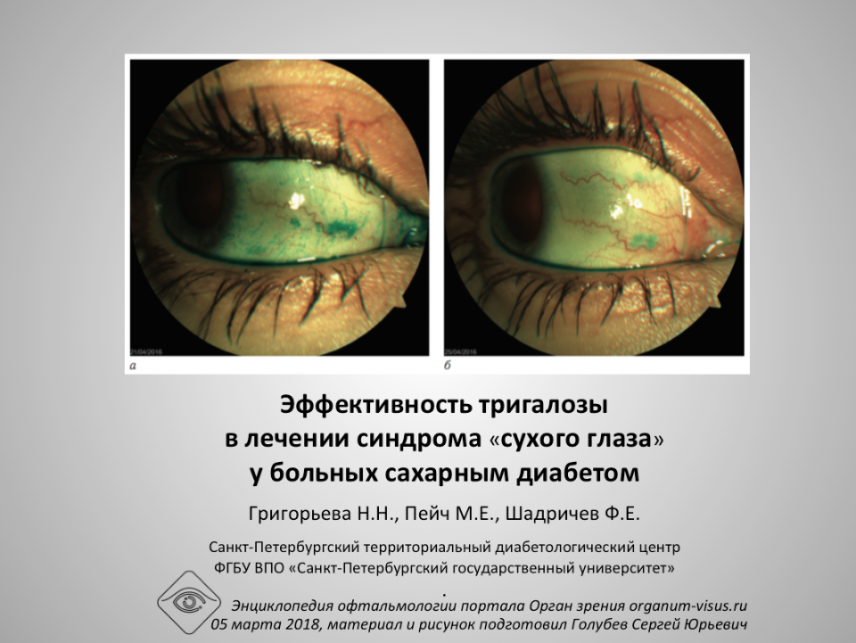 Тригалоза и сахарный диабет Григорьева Н.Н. с соавт.