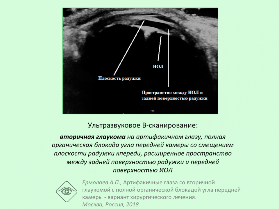 Лечение глаукомы при артифакии