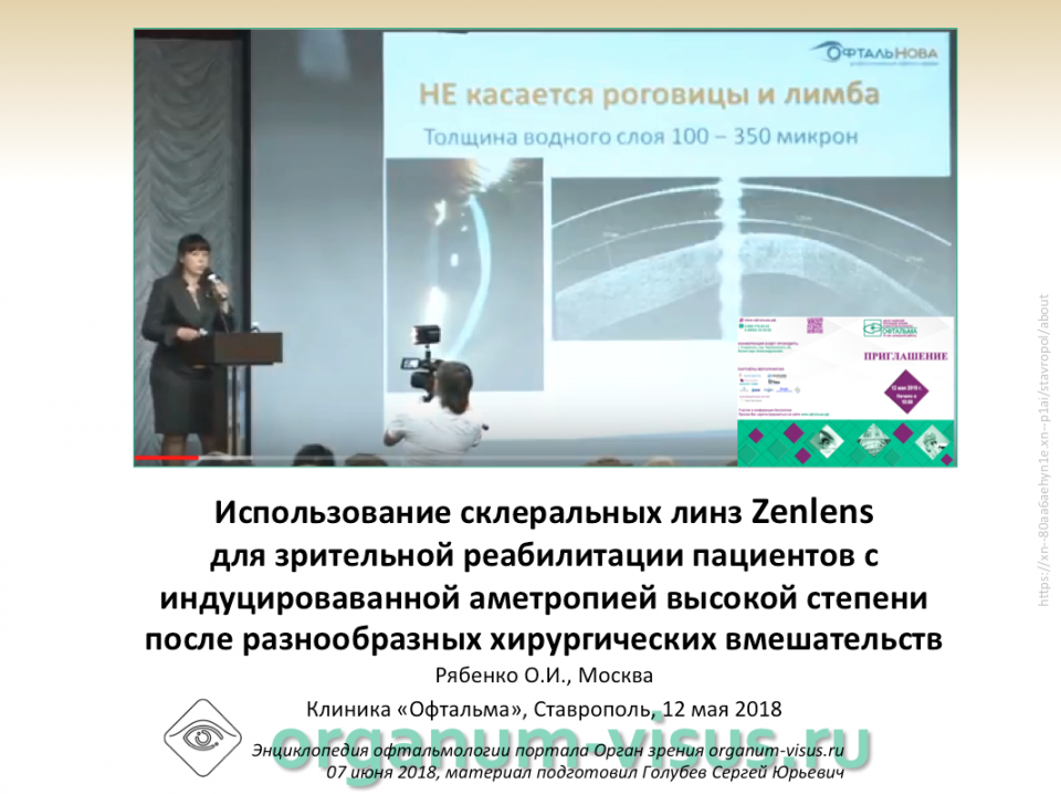Склеральные линзы Zenlens Рябенко О.И.