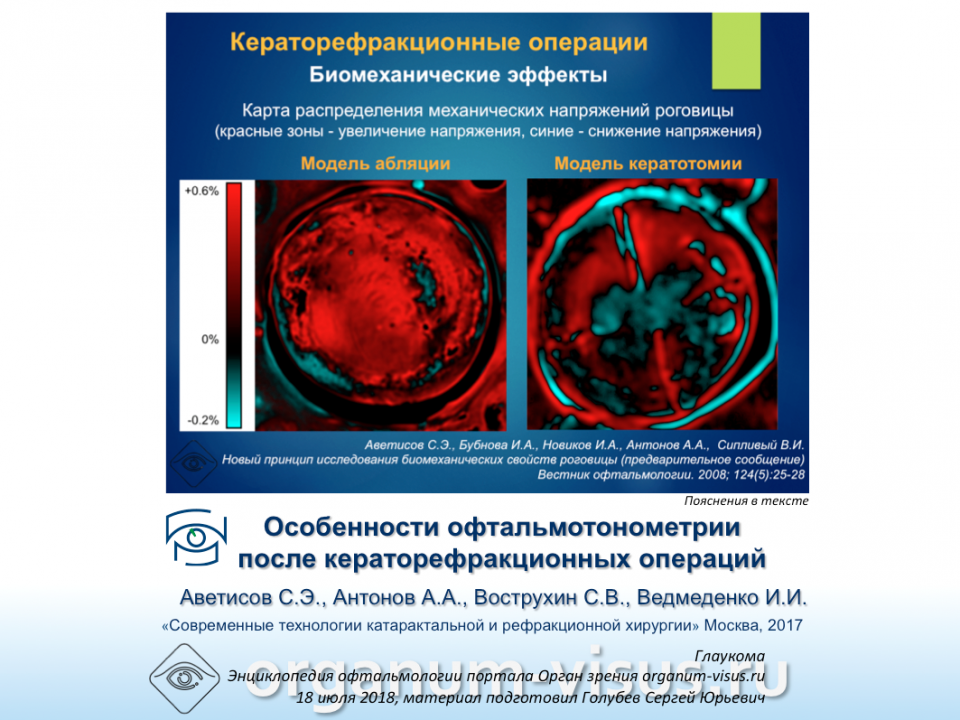 Глаукома Офтальмотонометрия после рефракционных операций