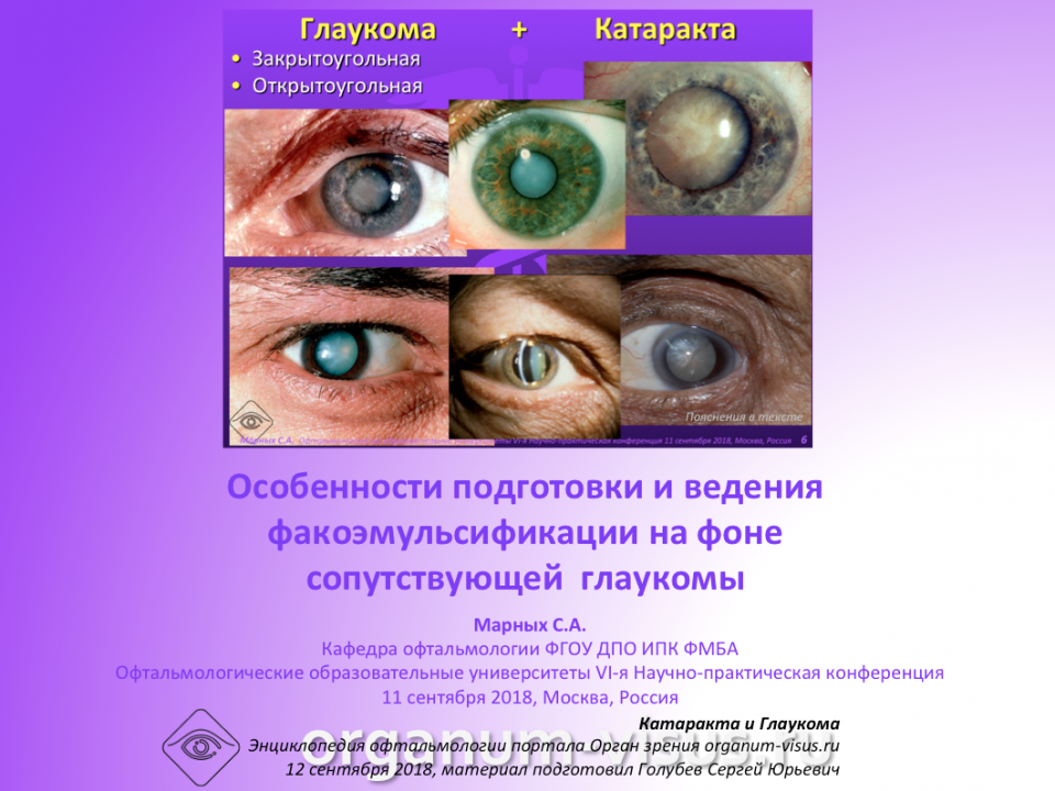 Глаукома и катаракта Особенности ведения пациентов