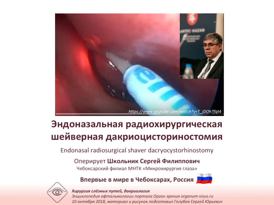 Дакриоцисториностомия Эндоназальная радиохирургия Оперирует С.Ф.Школьник
