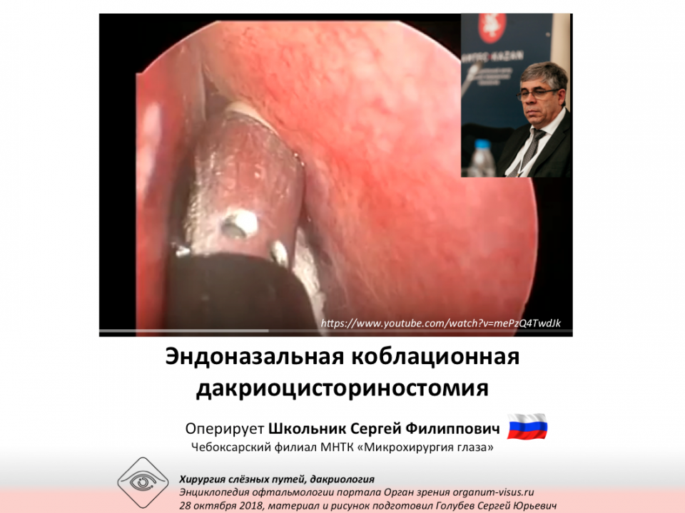 Дакриоцисториностомия коблационная Оперирует С.Ф.Школьник