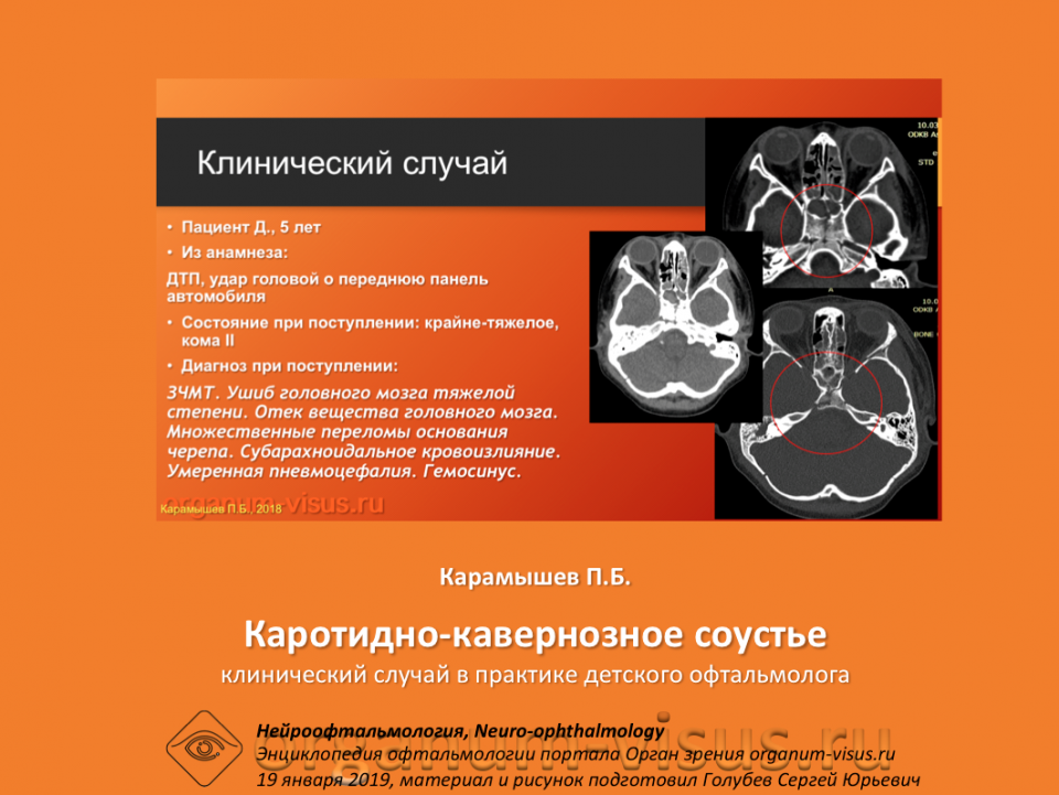 Каротидно кавернозное соустье Карамышев П.Б.