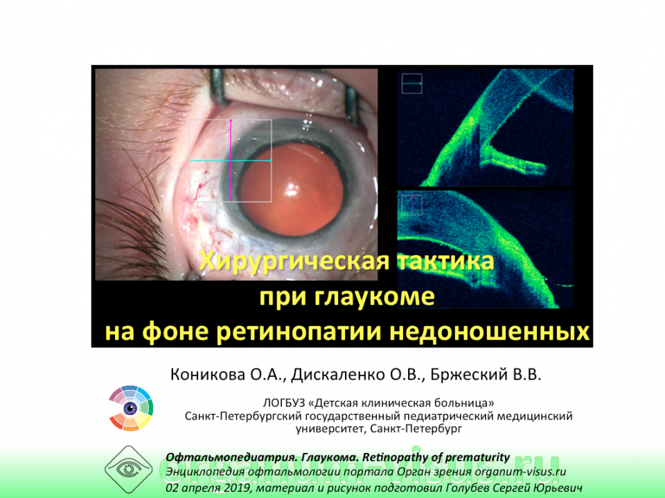 Глаукома и ретинопатия недоношенных