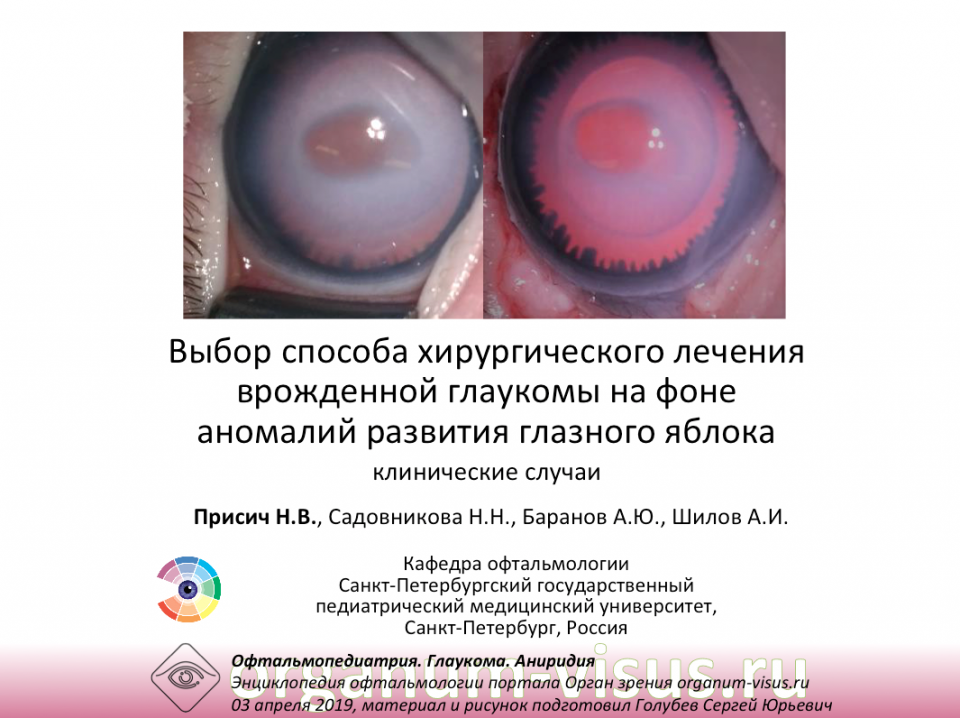 Глаукома и аниридия Тактика лечения
