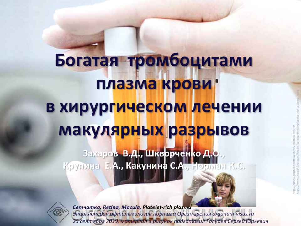Макулярный разрыв Лечение Богатая тромбоцитами плазма крови