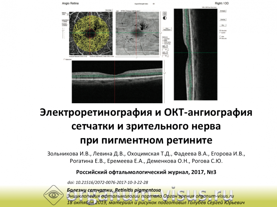 Пигментный ретинит ЭРГ и ОКТангио Зольникова И.В. с соавт