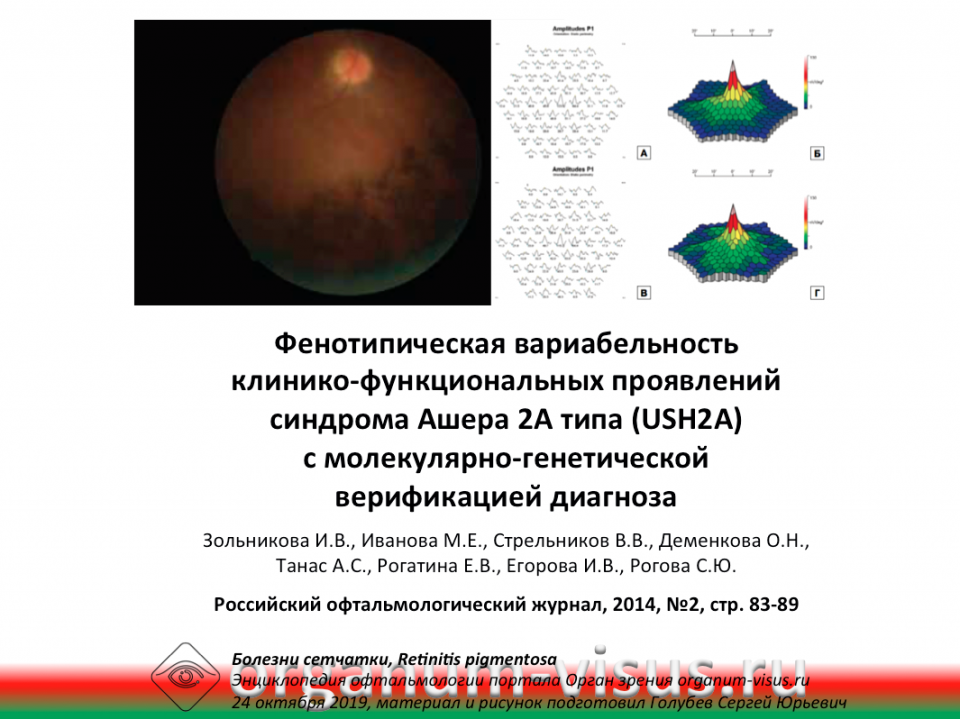 Синдрома Ашера 2А типа USH2A Фенотипическая вариабельность