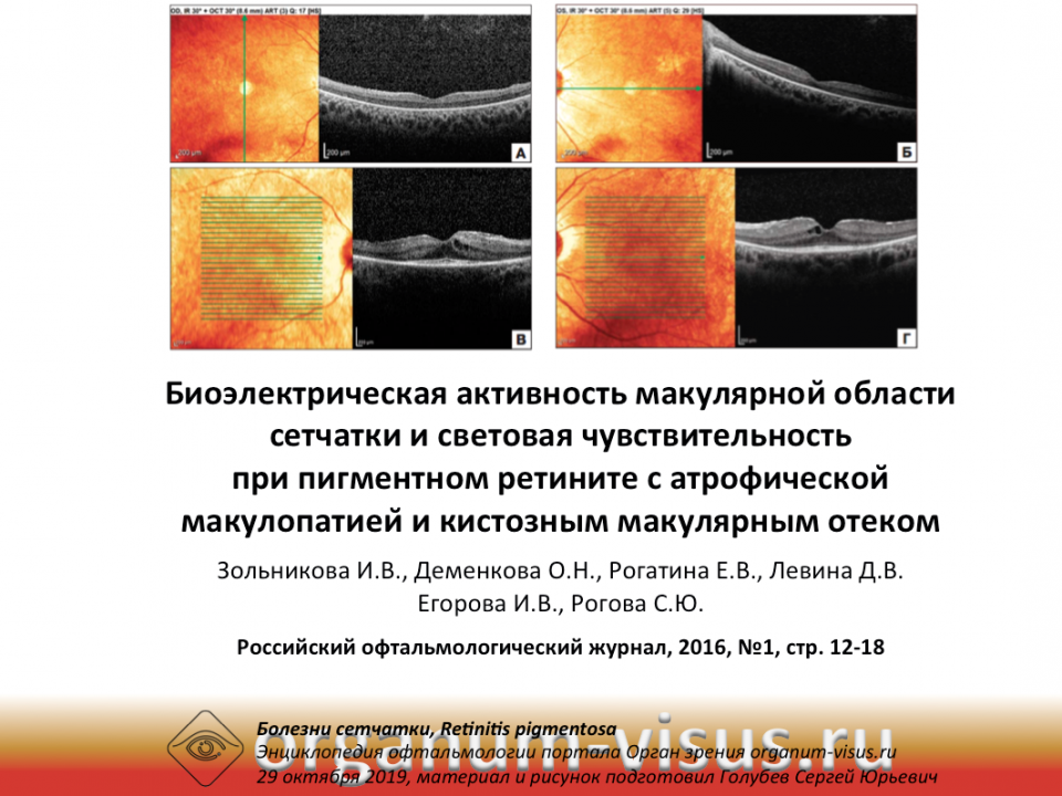 Биоэлектрическая активность макулярной области при пигментном ретините