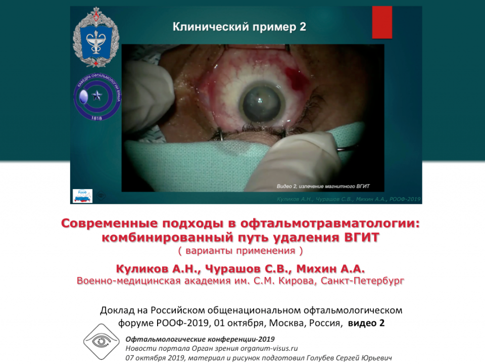 Травма глаза Удаление ВГИТ Видео 2 Куликов А.Н. с соавт