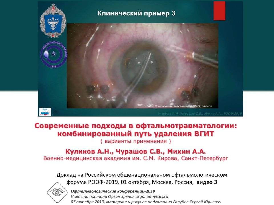 Травма глаза Удаление ВГИТ Видео 3 Куликов А.Н. с соавт
