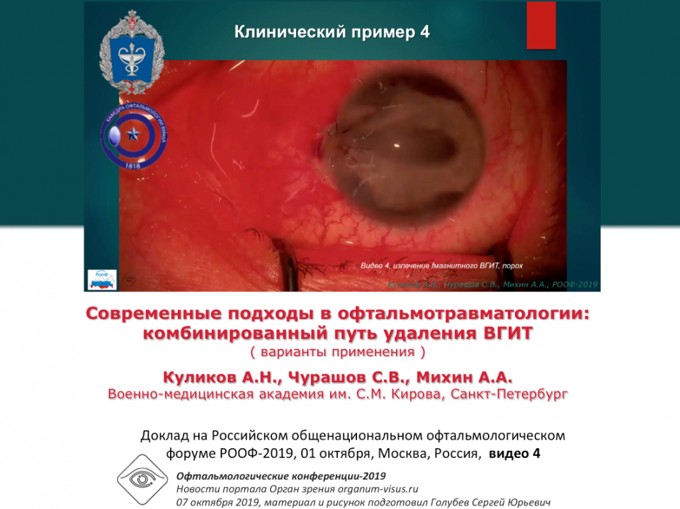 Травма глаза Удаление ВГИТ Видео 4 Куликов А.Н. с соавт