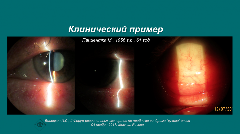 Рестасис Эндокринная патология Постменопауза