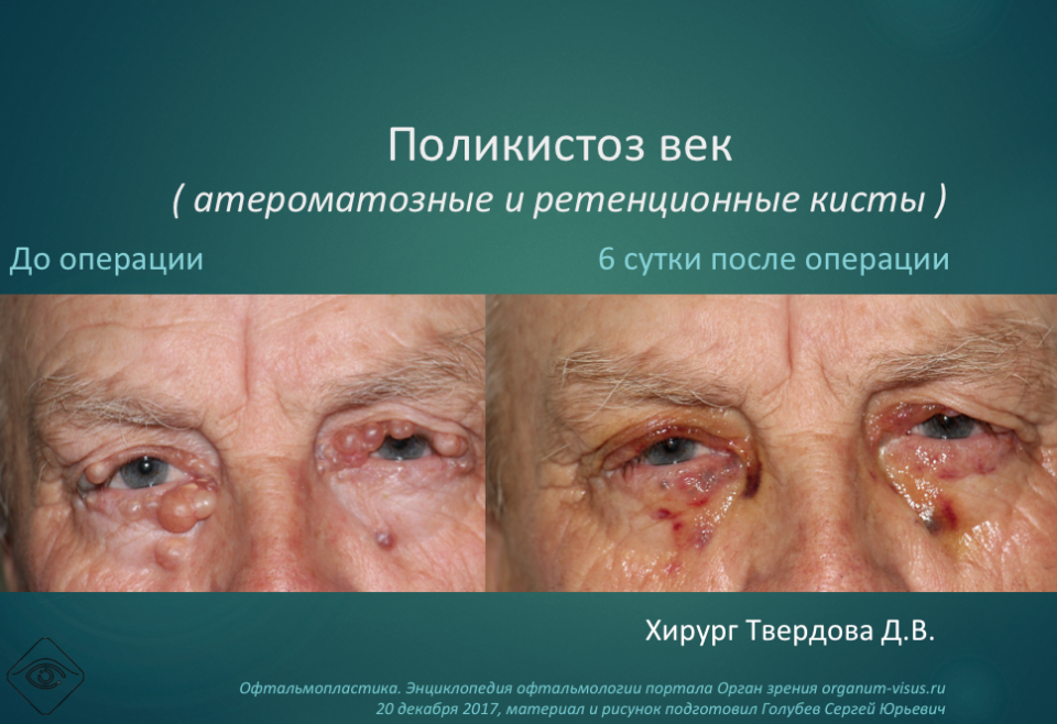 Офтальмопластика Лечение заболеваний век