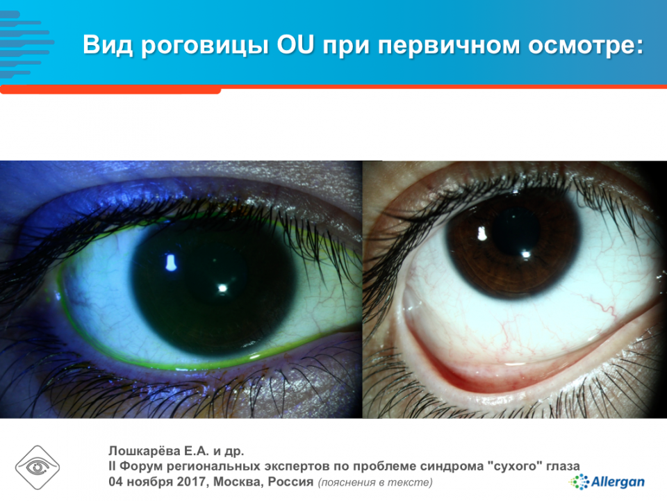 синдром сухого глаза симптомы. синдром сухого глаза у ребенка. осложнения бактериального конъюнктивита. симптомы чиндрома сузого новща.