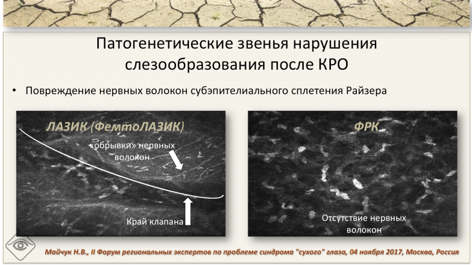 Сухой глаз и рефракционная хирургия