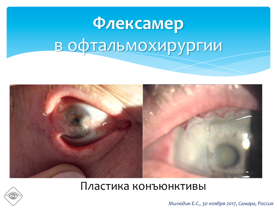 Офтальмопластика Биоматериал Флексамер в офтальмохирургии