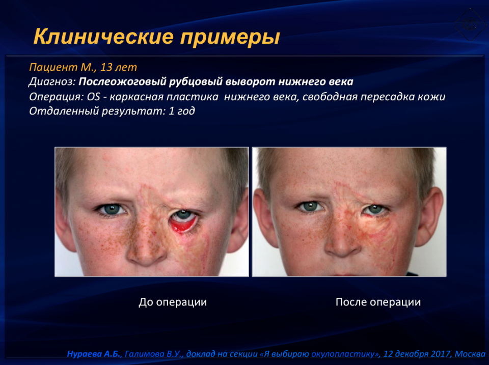 Офтальмопластика Лечение выворота нижнего века