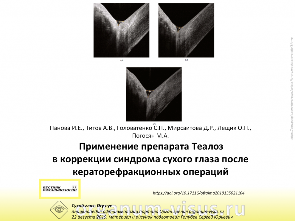 Сухой глаз Теалоз Рефракционная хирургия Панова И.Е. с соавт.