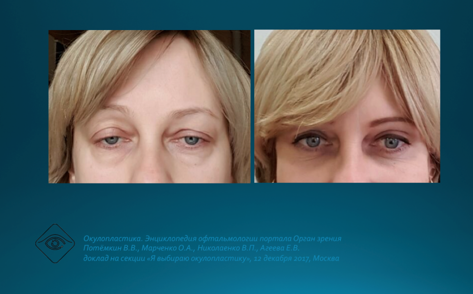 Офтальмопластика Мюллерэктомия в лечении блефароптоза