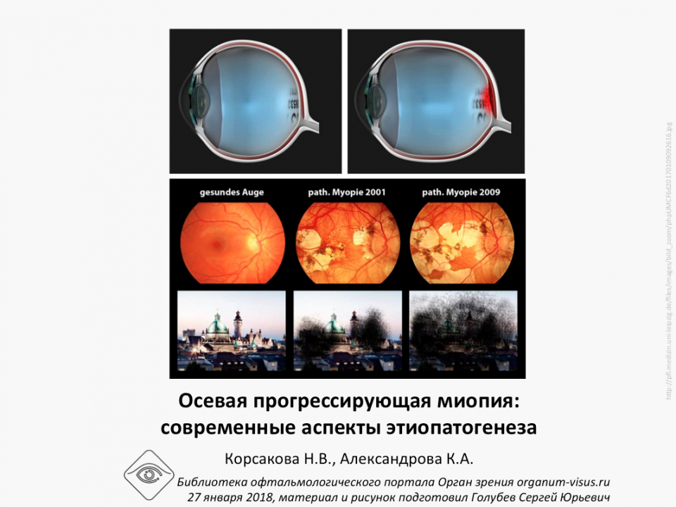 Осевая миопия Корсакова Н.В. Александрова К.А.