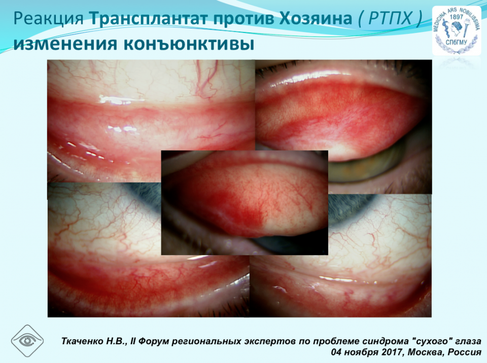 Циклоспорин 0,05% Системная аутоимунная патология