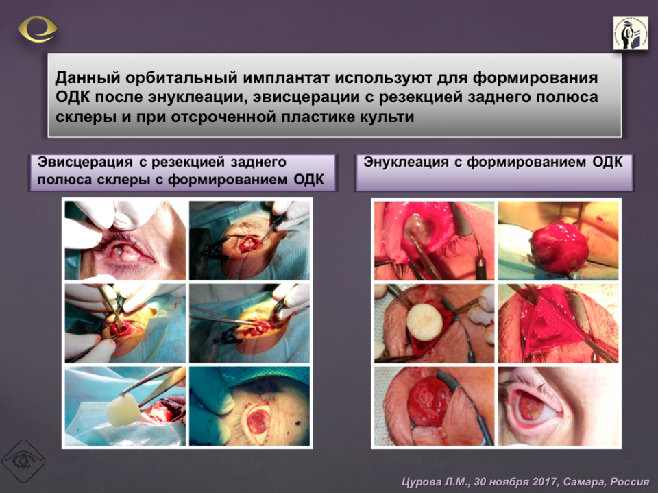 Офтальмопластика Аллогенные трансплантаты