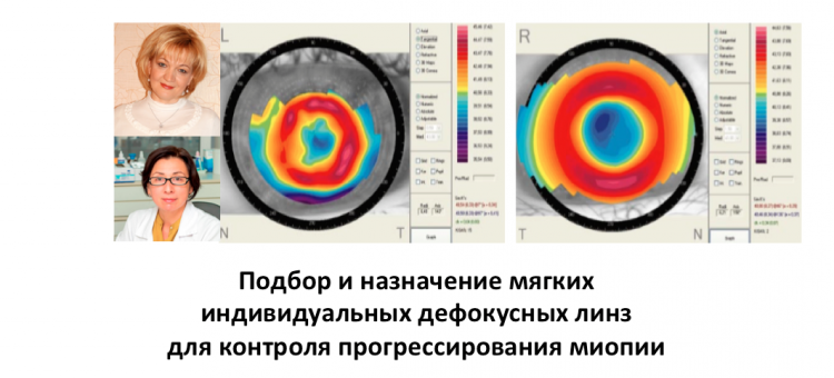 Контроль миопии Парфенова Н.П., Проскурина О.В.