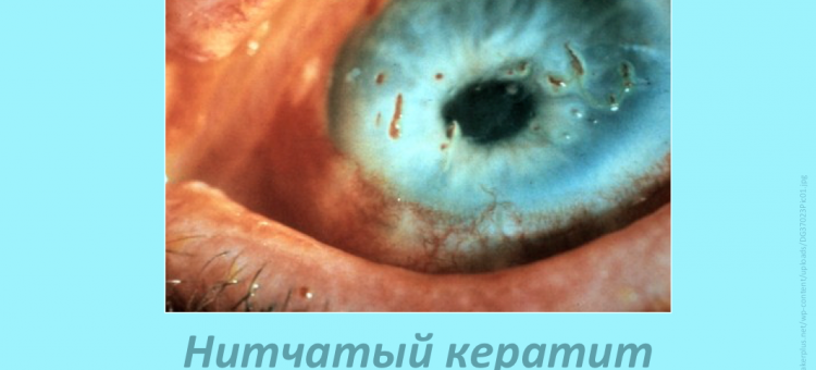 Лечение сухого глаза Нитчатый кератит