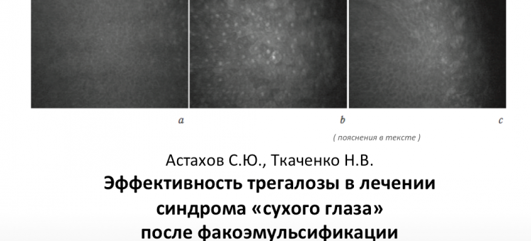 Сухой глаз Трегалоза после факоэмульсификации
