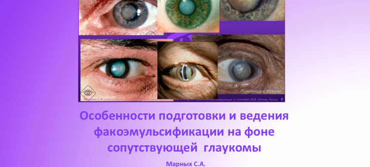 Глаукома и катаракта Особенности ведения пациентов