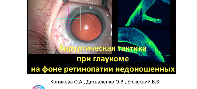 Глаукома и ретинопатия недоношенных