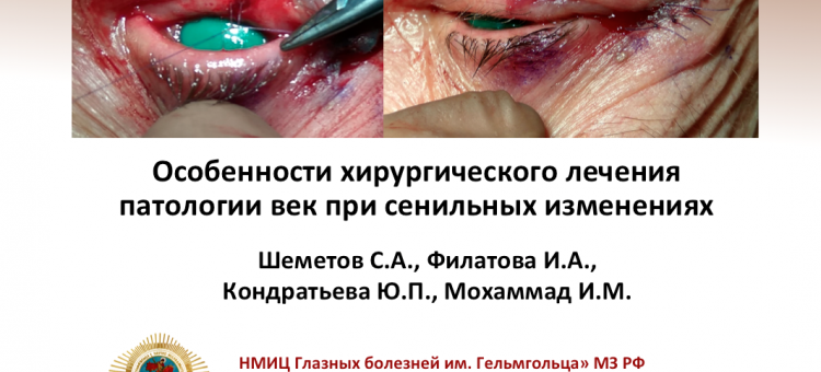 Офтальмопластика Сенильные изменения век