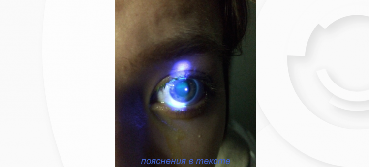 Сухой глаз Лечение Циклоспорин 0,05%