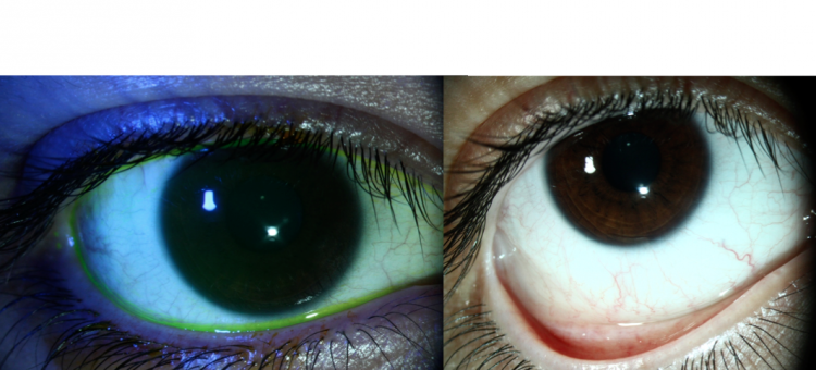 Циклоспорин А 0,05% Рутинное использование