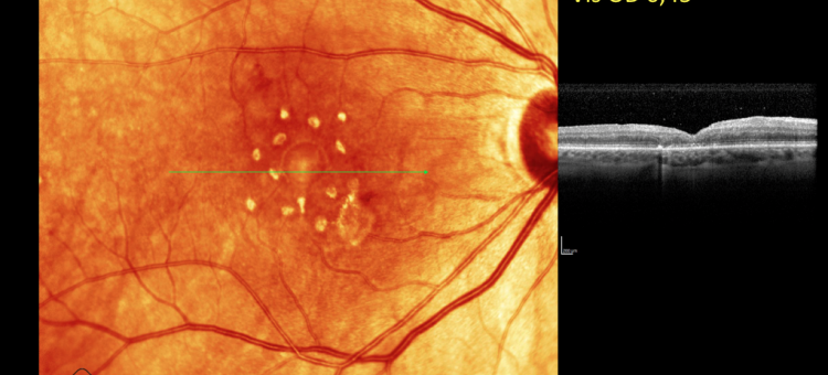 Сетчатка Ошибки лечения витреомакулярного тракционного синдрома Столяренко Г.Е.