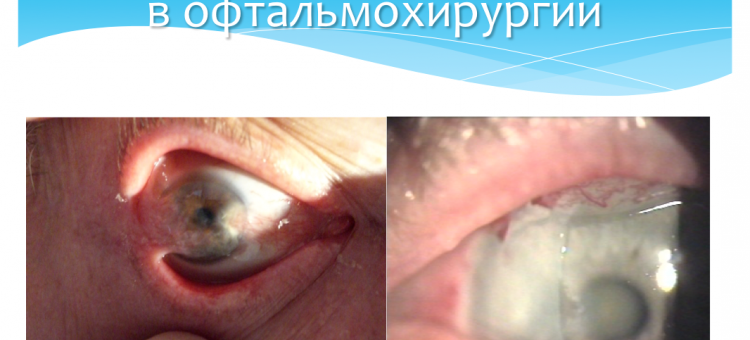 Офтальмопластика Биоматериал Флексамер в офтальмохирургии