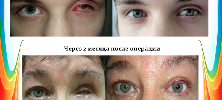 Офтальмопластика Восстановление век и Эвисцерация