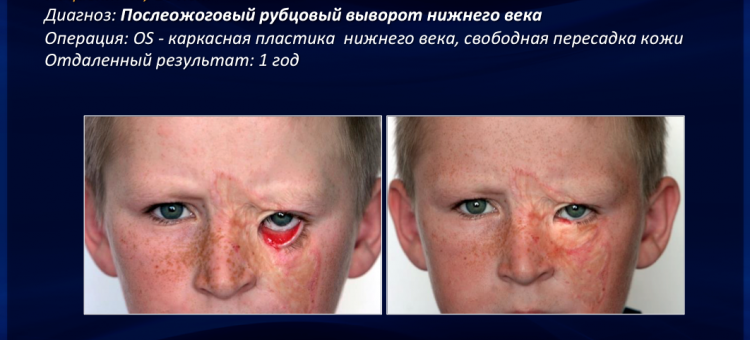 Офтальмопластика Лечение выворота нижнего века