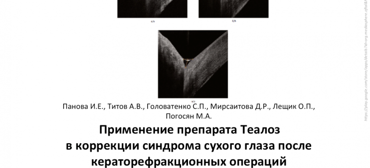Сухой глаз Теалоз Рефракционная хирургия Панова И.Е. с соавт.