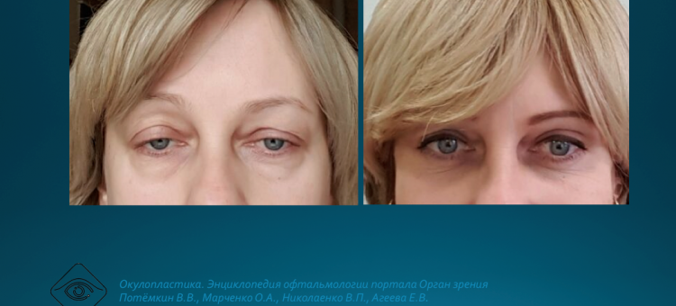 Офтальмопластика Мюллерэктомия в лечении блефароптоза