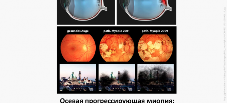 Осевая миопия Корсакова Н.В. Александрова К.А.