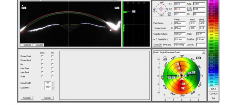 Факоэмульсификация прозрачного хрусталика ИОЛ Panoptix TFNT